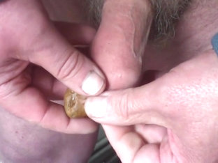 Foreskin with a stone